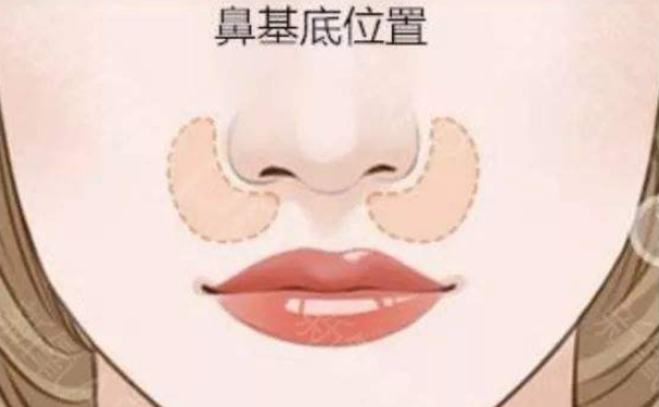 北京欧华PARKSUNMYUNG(朴宣洺)玻尿酸去鼻唇沟一般多少钱?案例反馈,价格表